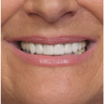 Up-close shot of Cathy's teeth after her cosmetic dental appointment.