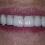 Up-close shot of Libby's smile after her implant dentistry appointment