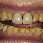 Up-close photo of Nancy's smile before wearing ClearCorrect aligners and getting cosmetic services done.