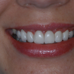 Up-close photo of Nicole's teeth after wearing ClearCorrect aligners and getting cosmetic services done.