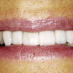 Upclose photo of Cathy's teeth after her cosmetic dentistry appointment.
