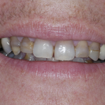 Up-close shot of Libby's smile before her dental implant appointment