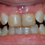 Up-close photo of Nicole's teeth before wearing ClearCorrect aligners and getting cosmetic services done.