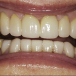 Up-close photo of Nancy's teeth after wearing ClearCorrect aligners and getting cosmetic services done.