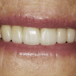 Up-close photo of Nancy's smile after wearing ClearCorrect aligners and getting cosmetic services done.