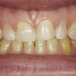 Up-close photo of Tracy's teeth before her Durathin veneers appointment.