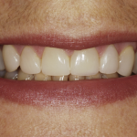 Up-close photo of Tracy after her Durathin veneers appointment.