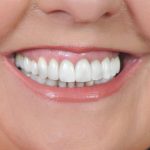 Up-close photo of Sandy's smile after her cosmetic dentistry appointment