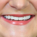 Upclose photo of Lee Ann's smile after using ClearCorrect aligners.