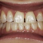 Up-close photo of Lee Ann's smile before using ClearCorrect Aligners.