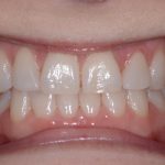 Up-close photo of Lee Ann's smile after using ClearCorrect aligners.