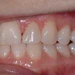 Up-close photo of Lee Ann's smile after using ClearCorrect aligners.